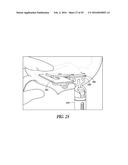 INSTRUMENTS AND METHODS IN PERFORMING KINEMATICALLY-ALIGNED TOTAL KNEE     ARTHROPLASTY diagram and image