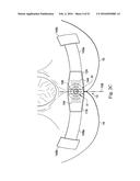 Externally Applied Intrapartum Support Device diagram and image