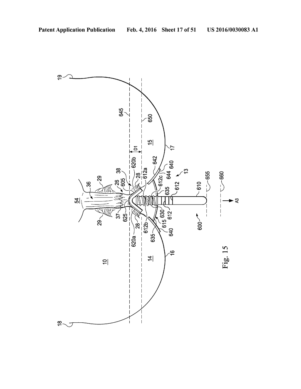 Externally Applied Intrapartum Support Device - diagram, schematic, and image 18