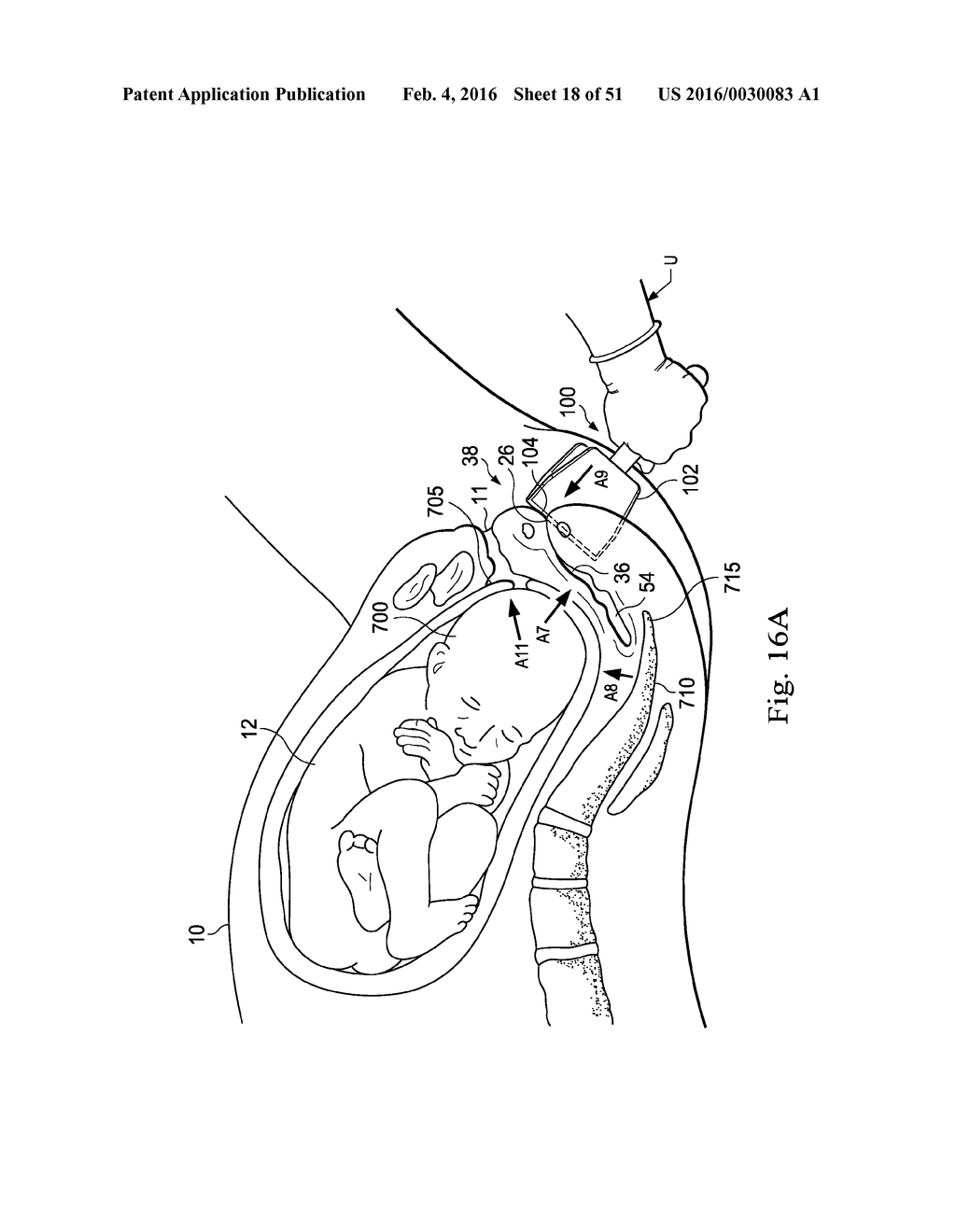 Externally Applied Intrapartum Support Device - diagram, schematic, and image 19