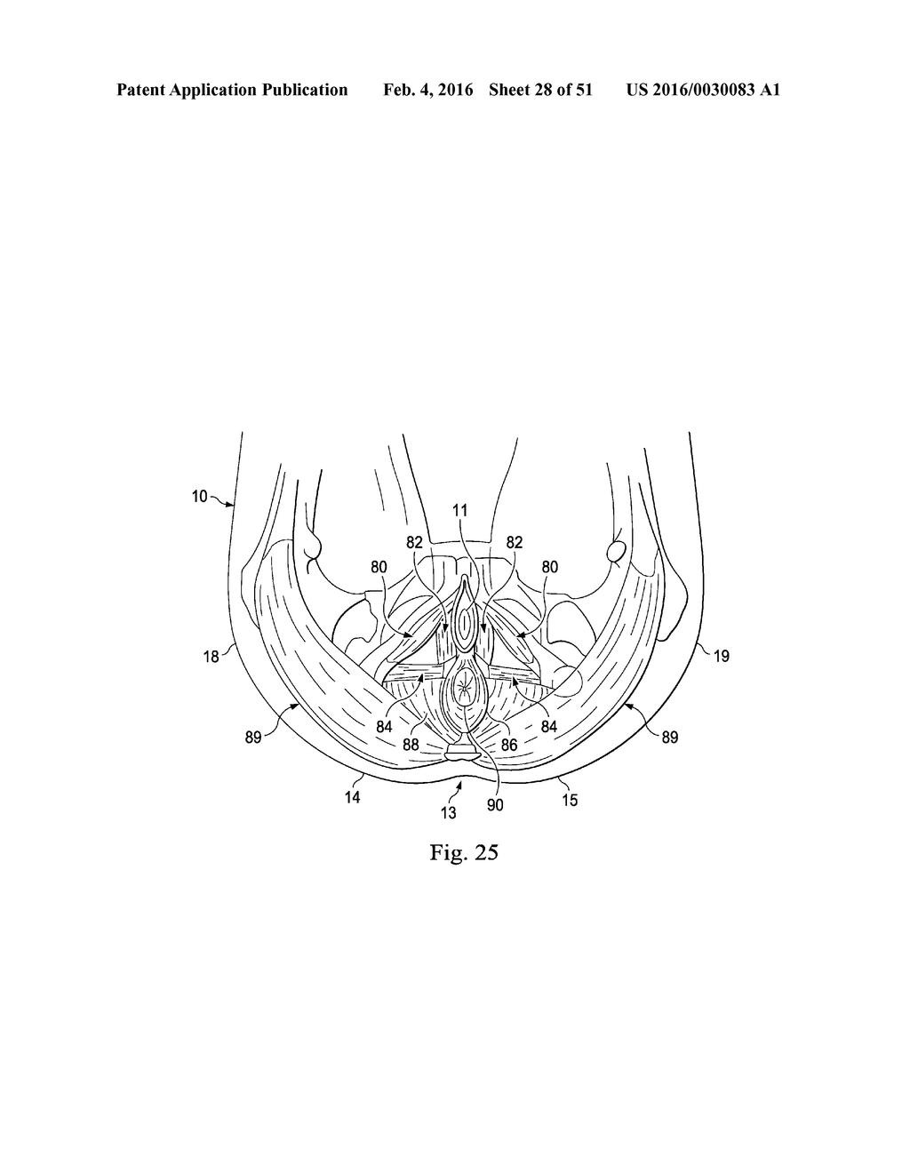 Externally Applied Intrapartum Support Device - diagram, schematic, and image 29