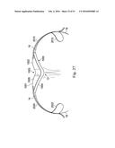 Externally Applied Intrapartum Support Device diagram and image