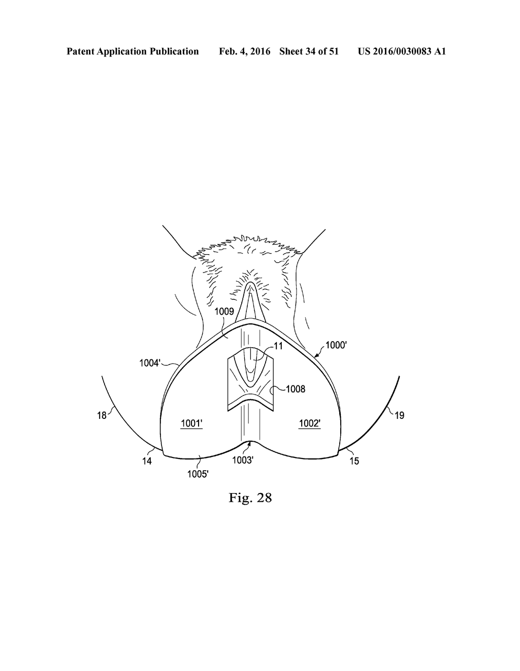 Externally Applied Intrapartum Support Device - diagram, schematic, and image 35