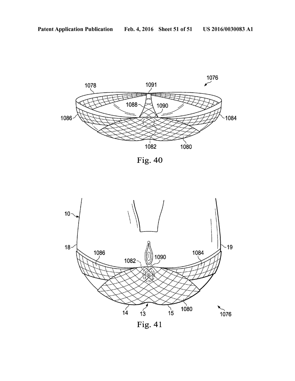 Externally Applied Intrapartum Support Device - diagram, schematic, and image 52