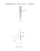 Methods and Devices for Spinal Screw Insertion diagram and image