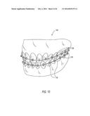 Static Self-Ligating Orthodontic Bracket and Method of Using Same diagram and image