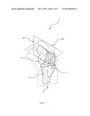 METHOD OF IMPLANTING A UNICONDYLAR KNEE PROSTHESIS diagram and image