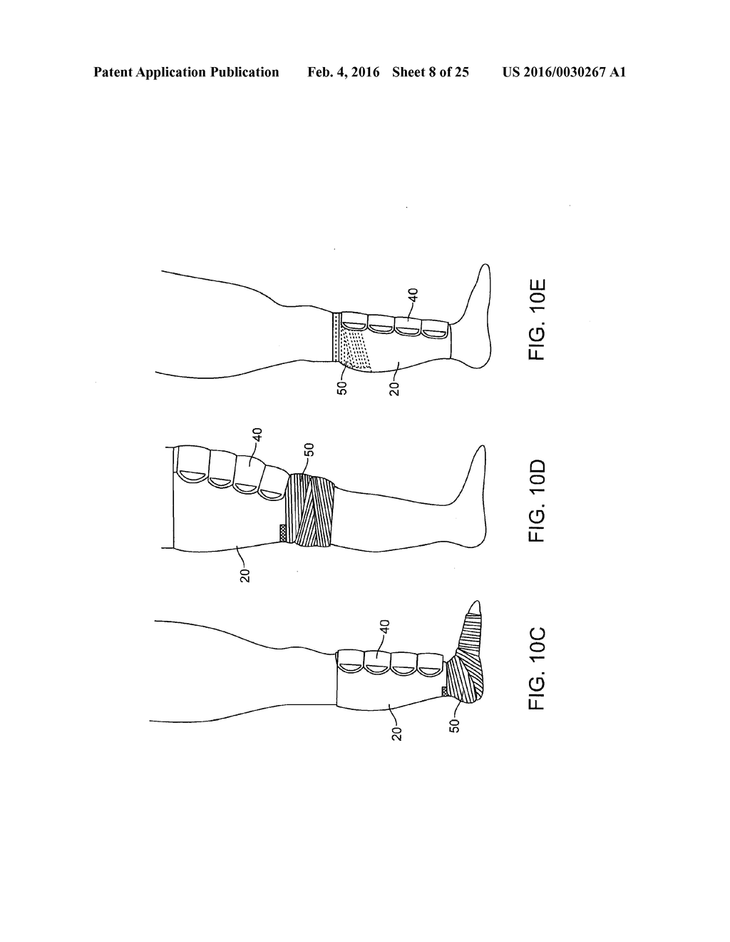 GRADUATED COMPRESSION DEVICE HAVING SEPARATE BODY AND BANDS - diagram, schematic, and image 09