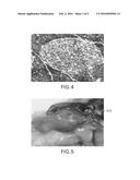 METHOD FOR REVERSING RECENT-ONSET TYPE 1 DIABETES (T1D) BY ADMINISTERING     SUBSTANCE P (sP) diagram and image