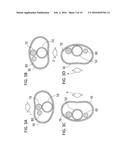 CATHETER diagram and image