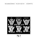 METHODS FOR TREATING OSTEOGENESIS IMPERFECTA diagram and image