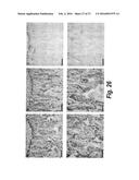 METHODS FOR TREATING OSTEOGENESIS IMPERFECTA diagram and image