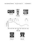 Diagnostic Method Using PALB2/US diagram and image