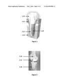 A Method of Determining an Indicator for the Stability of a Bone Implant diagram and image