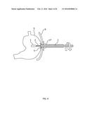 ENDOSCOPE diagram and image