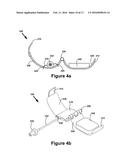 BALLOON ASSEMBLY FOR USE IN A HEMOSTASIS BAND diagram and image