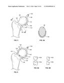 FEMORAL ACETABULAR IMPINGEMENT GUIDE diagram and image