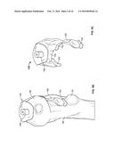 FEMORAL ACETABULAR IMPINGEMENT GUIDE diagram and image