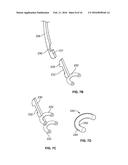 FEMORAL ACETABULAR IMPINGEMENT GUIDE diagram and image