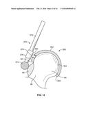 FEMORAL ACETABULAR IMPINGEMENT GUIDE diagram and image