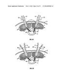 MINIMALLY INVASIVE RETRACTOR AND METHODS OF USE diagram and image