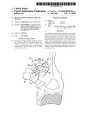 BONE FIXATION TENSIONING TOOL AND METHOD diagram and image