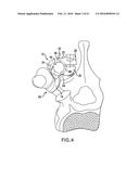 BONE FIXATION TENSIONING TOOL AND METHOD diagram and image