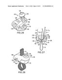 BONE FIXATION TENSIONING TOOL AND METHOD diagram and image