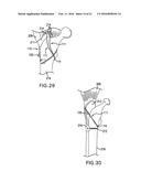 BONE FIXATION TENSIONING TOOL AND METHOD diagram and image