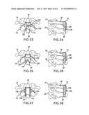 BONE FIXATION TENSIONING TOOL AND METHOD diagram and image