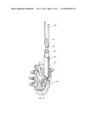 RETRACTION DEVICES, SYSTEMS, AND METHODS FOR MINIMALLY INVASIVE SPINAL     SURGERY diagram and image