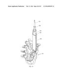 RETRACTION DEVICES, SYSTEMS, AND METHODS FOR MINIMALLY INVASIVE SPINAL     SURGERY diagram and image