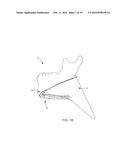 MANDIBULAR BONE PLATE diagram and image