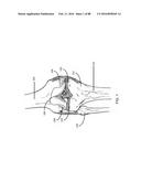 METHOD FOR CREATING A CUSTOMIZED ARTHROPLASTY RESECTION GUIDE UTILIZING     TWO-DIMENSIONAL IMAGING diagram and image