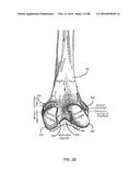 METHOD FOR CREATING A CUSTOMIZED ARTHROPLASTY RESECTION GUIDE UTILIZING     TWO-DIMENSIONAL IMAGING diagram and image