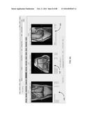 METHOD FOR CREATING A CUSTOMIZED ARTHROPLASTY RESECTION GUIDE UTILIZING     TWO-DIMENSIONAL IMAGING diagram and image