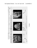 METHOD FOR CREATING A CUSTOMIZED ARTHROPLASTY RESECTION GUIDE UTILIZING     TWO-DIMENSIONAL IMAGING diagram and image