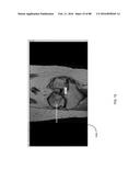 METHOD FOR CREATING A CUSTOMIZED ARTHROPLASTY RESECTION GUIDE UTILIZING     TWO-DIMENSIONAL IMAGING diagram and image