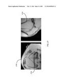 METHOD FOR CREATING A CUSTOMIZED ARTHROPLASTY RESECTION GUIDE UTILIZING     TWO-DIMENSIONAL IMAGING diagram and image