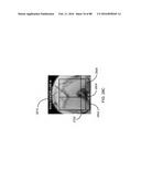 METHOD FOR CREATING A CUSTOMIZED ARTHROPLASTY RESECTION GUIDE UTILIZING     TWO-DIMENSIONAL IMAGING diagram and image