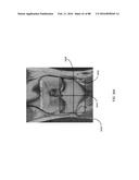 METHOD FOR CREATING A CUSTOMIZED ARTHROPLASTY RESECTION GUIDE UTILIZING     TWO-DIMENSIONAL IMAGING diagram and image