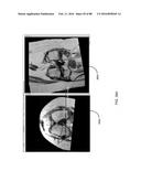 METHOD FOR CREATING A CUSTOMIZED ARTHROPLASTY RESECTION GUIDE UTILIZING     TWO-DIMENSIONAL IMAGING diagram and image