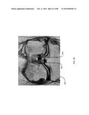 METHOD FOR CREATING A CUSTOMIZED ARTHROPLASTY RESECTION GUIDE UTILIZING     TWO-DIMENSIONAL IMAGING diagram and image