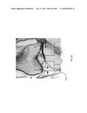 METHOD FOR CREATING A CUSTOMIZED ARTHROPLASTY RESECTION GUIDE UTILIZING     TWO-DIMENSIONAL IMAGING diagram and image