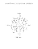 METHOD FOR CREATING A CUSTOMIZED ARTHROPLASTY RESECTION GUIDE UTILIZING     TWO-DIMENSIONAL IMAGING diagram and image