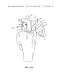 METHOD FOR CREATING A CUSTOMIZED ARTHROPLASTY RESECTION GUIDE UTILIZING     TWO-DIMENSIONAL IMAGING diagram and image