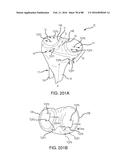 METHOD FOR CREATING A CUSTOMIZED ARTHROPLASTY RESECTION GUIDE UTILIZING     TWO-DIMENSIONAL IMAGING diagram and image