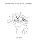 METHOD FOR CREATING A CUSTOMIZED ARTHROPLASTY RESECTION GUIDE UTILIZING     TWO-DIMENSIONAL IMAGING diagram and image