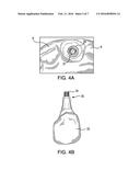 APPARATUSES AND METHODS FOR IMPLANTING DENTAL IMPLANTS diagram and image