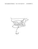 BONE FOUNDATION GUIDE SYSTEM AND METHOD diagram and image